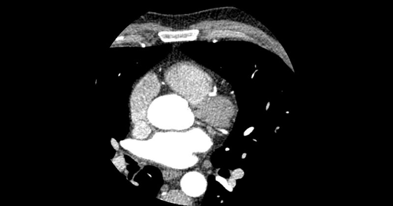 File:Aberrant left main coronary artery (ALMCA) arising from the right sinus with interarterial course (Radiopaedia 63251-71814 Axial C+ arterial phase 63).JPG