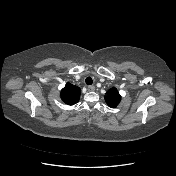 File:Aberrant right subclavian and left vertebral arteries (Radiopaedia 43467-46847 Axial C+ portal venous phase 13).jpg