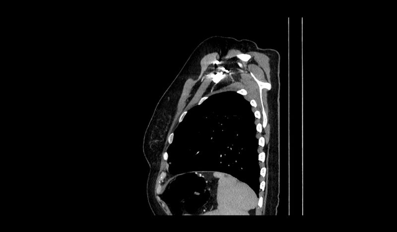 File:Acquired tracheo-esophageal fistula (Radiopaedia 51356-57103 Sagittal C+ arterial phase 1).jpg