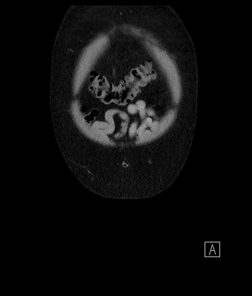 File:Acute-on-chronic pancreatitis (Radiopaedia 67286-76656 Coronal C+ portal venous phase 11).jpg