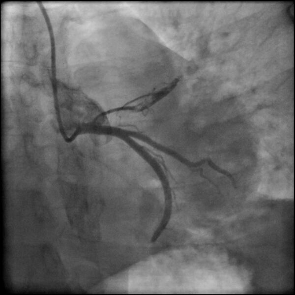File:Acute anteroseptal myocardial infarction (Radiopaedia 68409-77946 LAO caudal (spider view) LAD and CX 21).jpg
