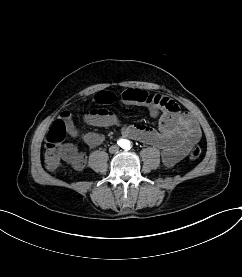 Acute arterial mesenteric ischemia (Radiopaedia 78238-90828 Axial C+ arterial phase 83).jpg