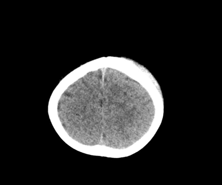 File:Acute epidural hematoma (Radiopaedia 63659-72335 Axial non-contrast 23).jpg