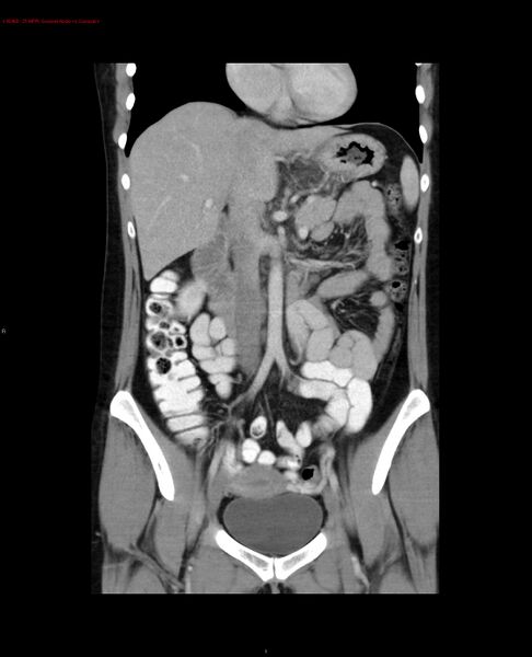File:Acute gastritis (Radiopaedia 21043-20975 Coronal C+ portal venous phase 15).jpg
