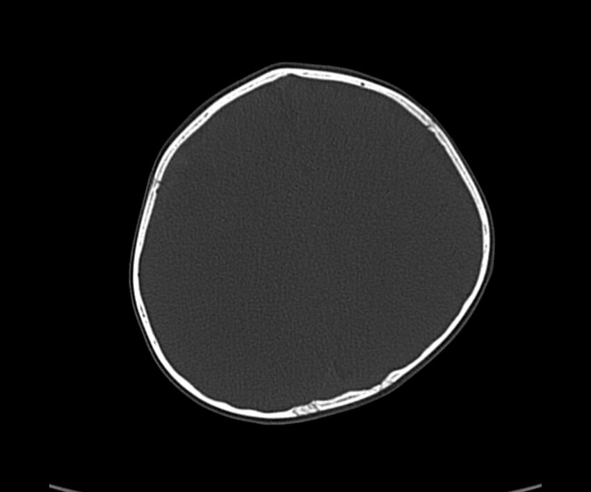 Acute hemorrhagic contusion (Radiopaedia 63660-72336 Axial bone window 47).jpg