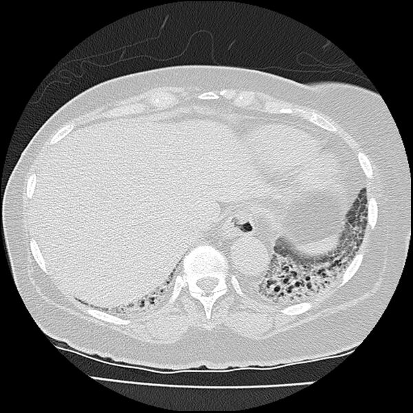 File:Acute interstitial pneumonitis (Radiopaedia 45404-49452 Axial lung window 77).jpg
