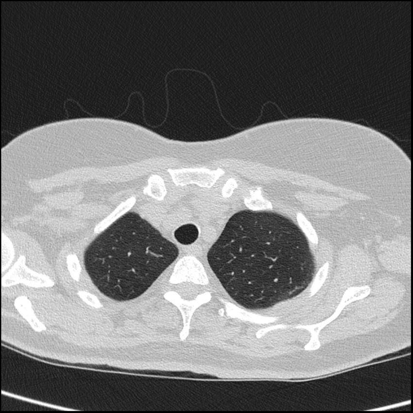 Acute interstitial pneumonitis (Radiopaedia 45404-49453 Axial lung window 14).jpg