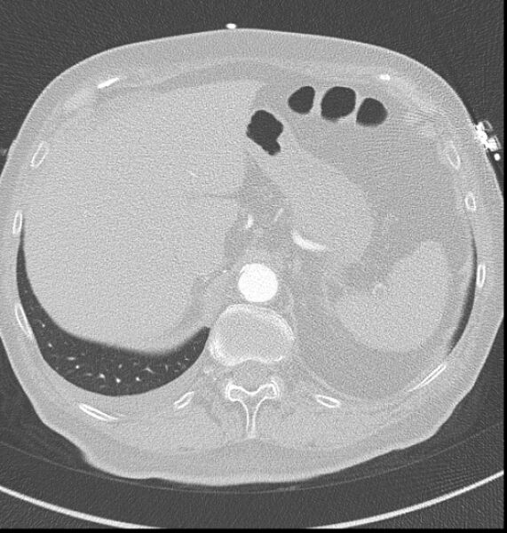 File:Acute myocardial infarction (Radiopaedia 23413-23481 lung window 70).jpg