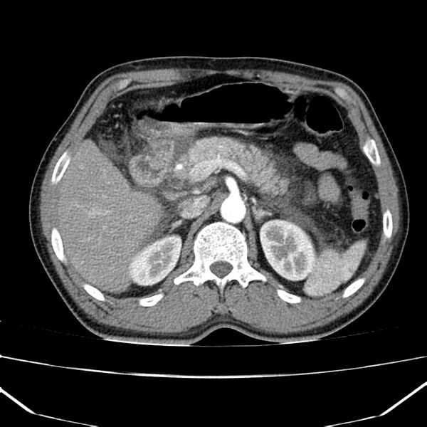 File:Acute pancreatitis (Radiopaedia 22572-22596 Axial C+ arterial phase 25).jpg