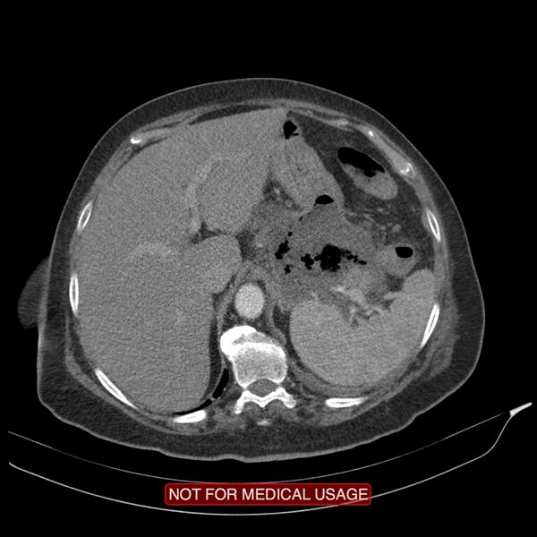 File:Acute pancreatitis with infected necrosis (Radiopaedia 26454-26585 Axial C+ arterial phase 7).jpg