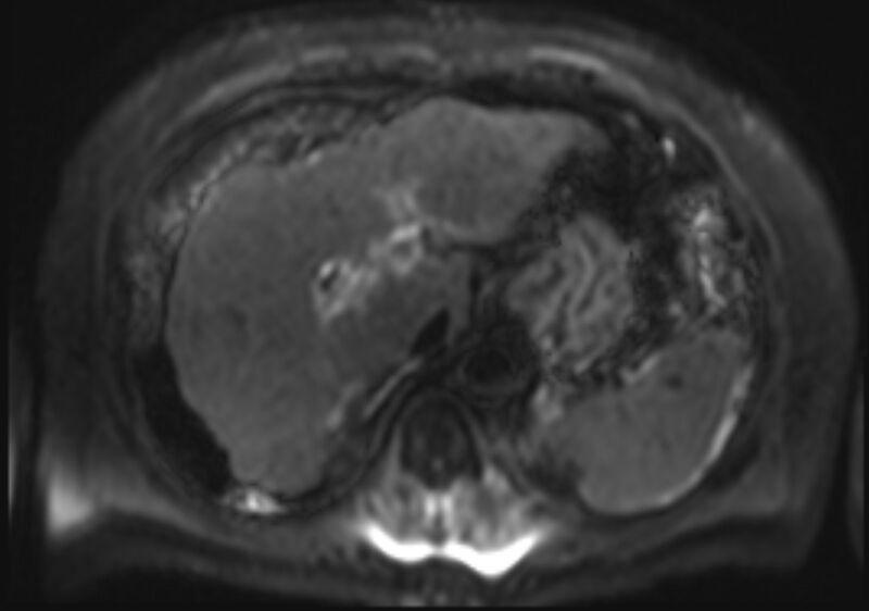 File:Acute portal vein thrombosis (Radiopaedia 73198-83925 Axial DWI 12).jpg