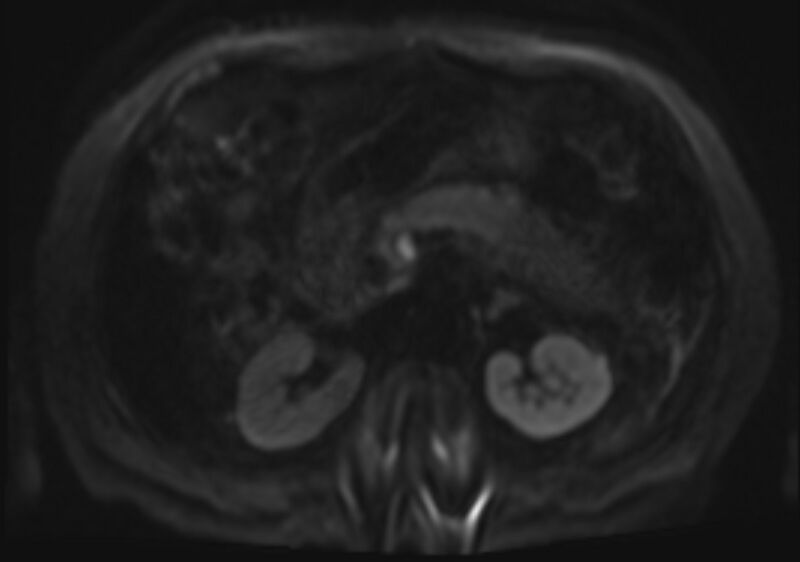 File:Acute portal vein thrombosis (Radiopaedia 73198-83925 Axial DWI 48).jpg
