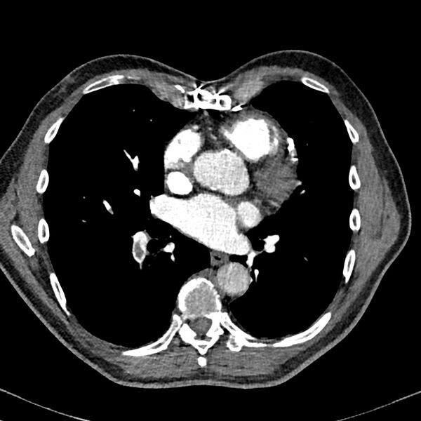 File:Acute pulmonary embolism (Radiopaedia 81677-95570 Axial C+ CTPA 66).jpg