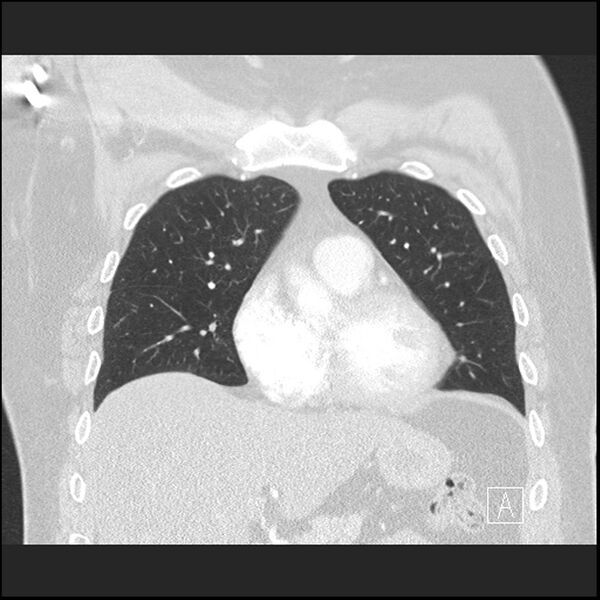 File:Acute pulmonary embolism with pulmonary infarct (Radiopaedia 73062-83768 Coronal lung window 25).jpg