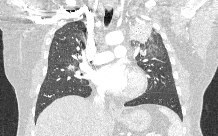 Acute pulmonary embolism with pulmonary infarcts (Radiopaedia 77688-89908 Coronal lung window 44).jpg