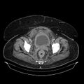 Acute pyelonephritis (Radiopaedia 25657-25837 Axial renal parenchymal phase 72).jpg