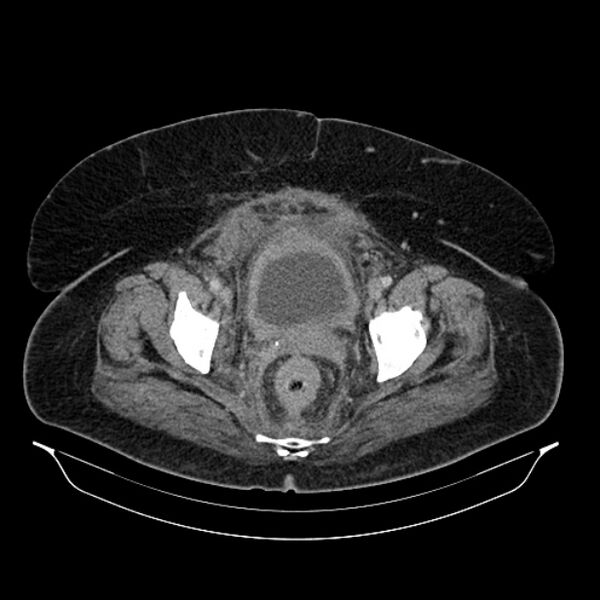 File:Acute pyelonephritis (Radiopaedia 25657-25837 Axial renal parenchymal phase 72).jpg