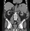 Acute renal failure post IV contrast injection- CT findings (Radiopaedia 47815-52557 Coronal non-contrast 27).jpg