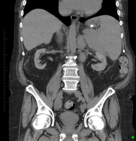 File:Acute renal failure post IV contrast injection- CT findings (Radiopaedia 47815-52557 Coronal non-contrast 27).jpg