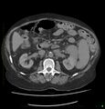 Acute renal failure post IV contrast injection- CT findings (Radiopaedia 47815-52559 Axial C+ portal venous phase 33).jpg