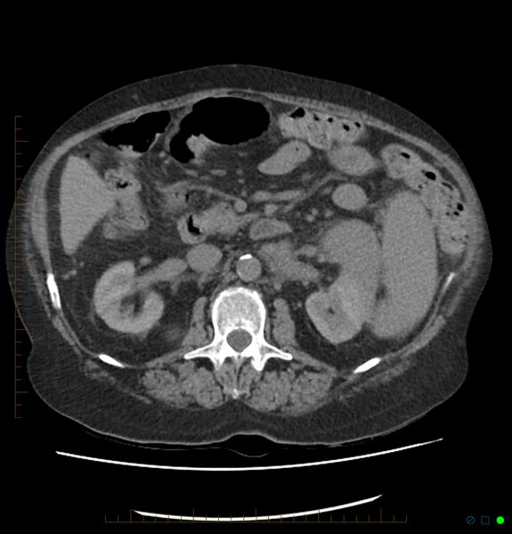 File:Acute renal failure post IV contrast injection- CT findings (Radiopaedia 47815-52559 Axial C+ portal venous phase 33).jpg