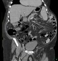 Acute renal failure post IV contrast injection- CT findings (Radiopaedia 47815-52559 Coronal C+ portal venous phase 7).jpg