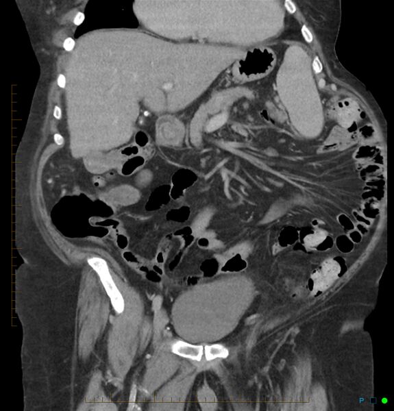 File:Acute renal failure post IV contrast injection- CT findings (Radiopaedia 47815-52559 Coronal C+ portal venous phase 7).jpg