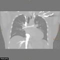 Acute reversible pulmonary hypertension and right heart failure from cocaine toxicity (Radiopaedia 49394-54517 Coronal C+ CTPA 22).jpg