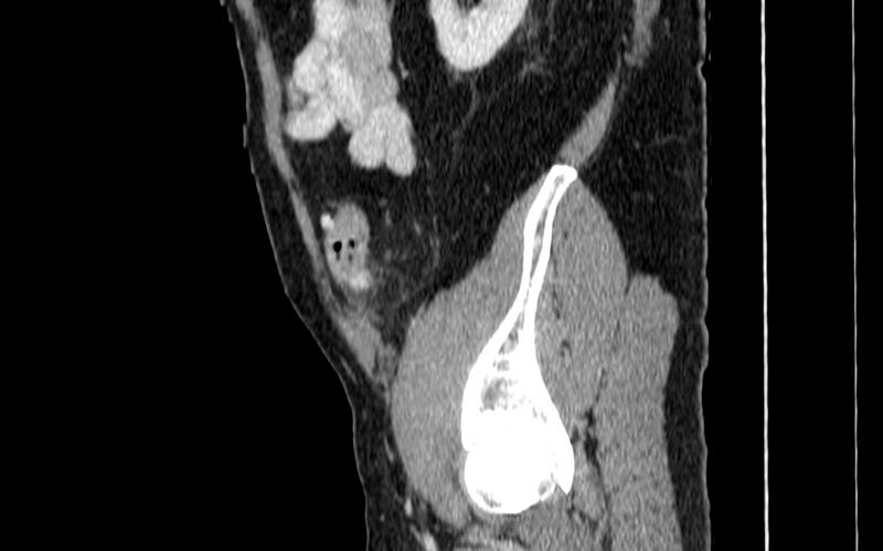 File:Acute sigmoid colon diverticulitis (Radiopaedia 55507-61976 Sagittal C+ portal venous phase 103).jpg