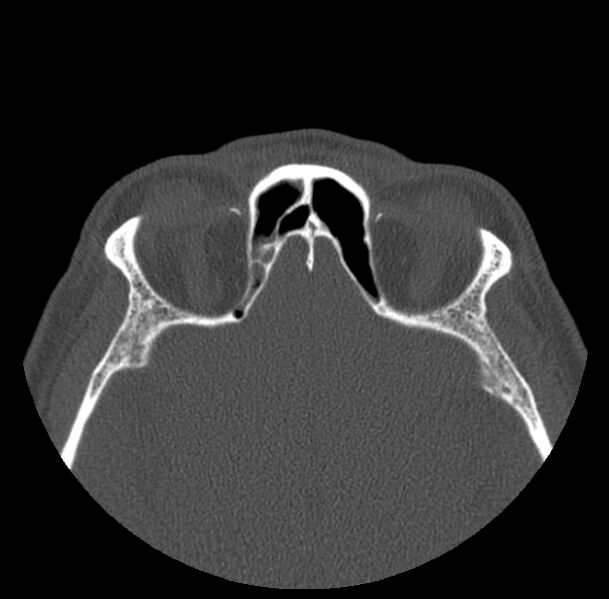 File:Acute sinusitis (Radiopaedia 23161-23215 Axial bone window 59).jpg
