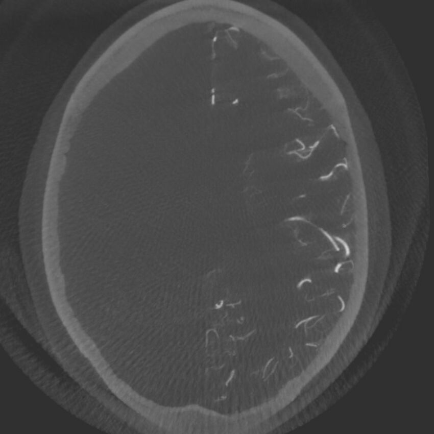 Acute subarachnoid hemorrhage and accessory anterior cerebral artery (Radiopaedia 69231-79010 C 47).jpg