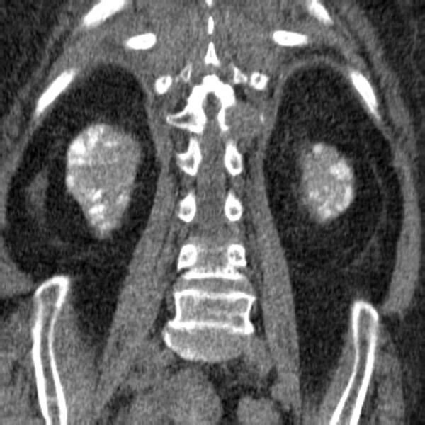 File:Acute tubular necrosis (Radiopaedia 28077-28334 Coronal non-contrast 27).jpg