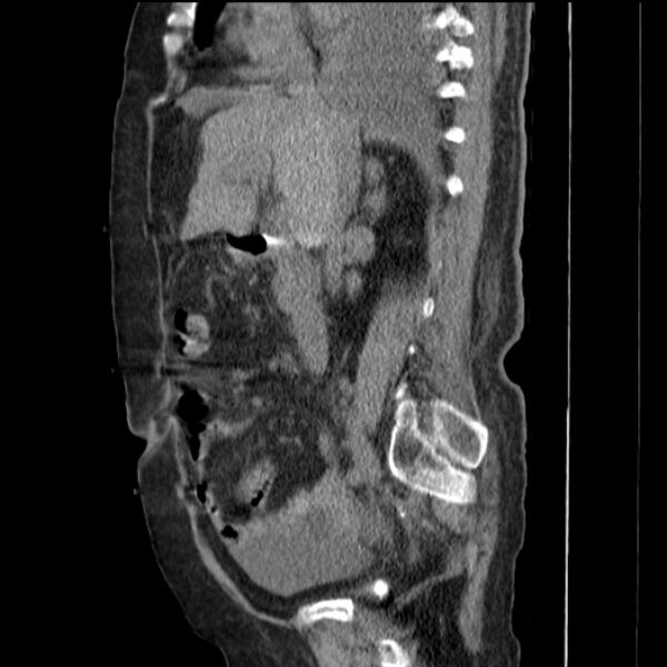 File:Acute tubular necrosis (Radiopaedia 28077-28334 H 38).jpg
