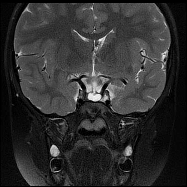 File:Adamantinomatous craniopharyngioma (Radiopaedia 77407-89529 Coronal T2 fat sat 5).jpg