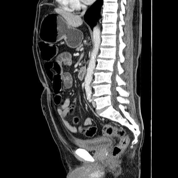 File:Adenocarcinoma of colon with entero-colic fistula (Radiopaedia 22832-22852 Sagittal C+ portal venous phase 33).jpg