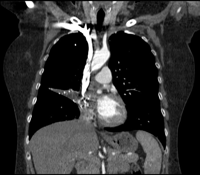 File:Adenocarcinoma of the lung (Radiopaedia 44205-47803 Coronal C+ portal venous phase 36).jpg