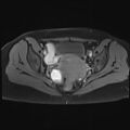 Adenomyosis and endometriotic cysts (Radiopaedia 82300-96367 Axial T1 C+ fat sat 12).jpg