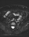 Adnexal multilocular cyst (O-RADS US 3- O-RADS MRI 3) (Radiopaedia 87426-103754 Axial T2 fat sat 1).jpg