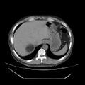 Adrenal myelolipoma (Radiopaedia 41843-44834 Axial non-contrast 5).jpg