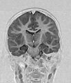 Aicardi syndrome (Radiopaedia 66029-75205 Coronal T1-IR 13).jpg