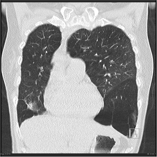 File:Alpha-1-antitrypsin deficiency (Radiopaedia 26537-26678 Coronal lung window 8).jpg