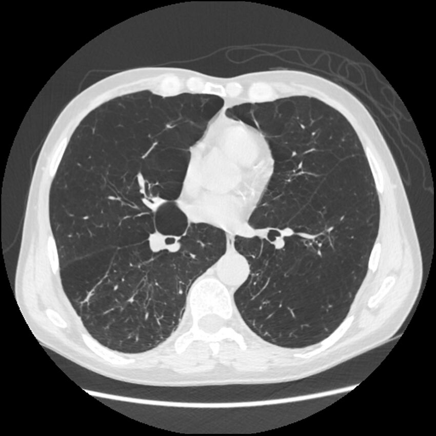 Alpha-1-antitrypsin deficiency (Radiopaedia 40993-43722 Axial lung window 136).jpg