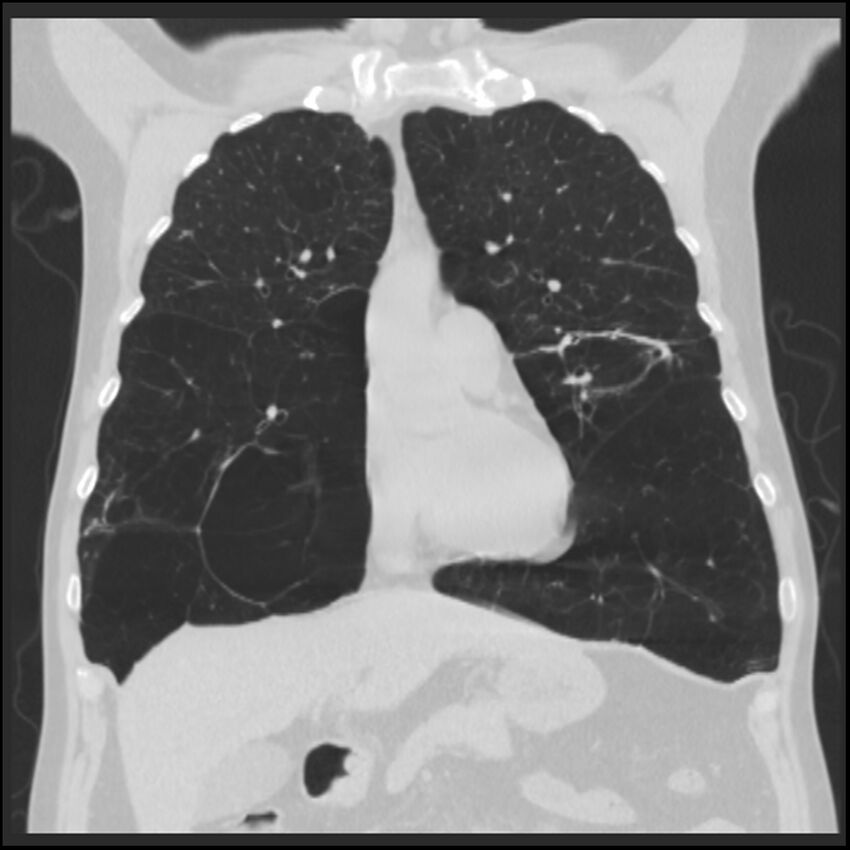 Alpha-1-antitrypsin deficiency (Radiopaedia 40993-43722 Coronal lung window 34).jpg