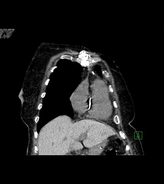 File:Amiodarone deposition in the liver (Radiopaedia 77587-89780 Coronal non-contrast 21).jpg
