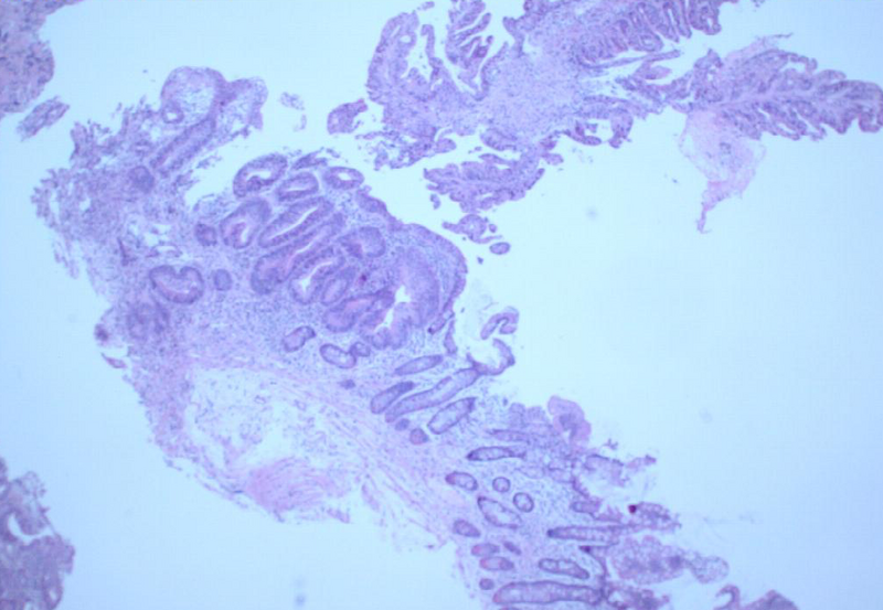 File:Ampullary adenocarcinoma (Radiopaedia 34013-35254 H&E 1).png
