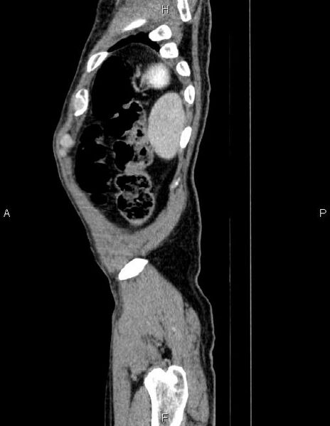 File:Ampullary adenocarcinoma (Radiopaedia 86093-102032 D 92).jpg
