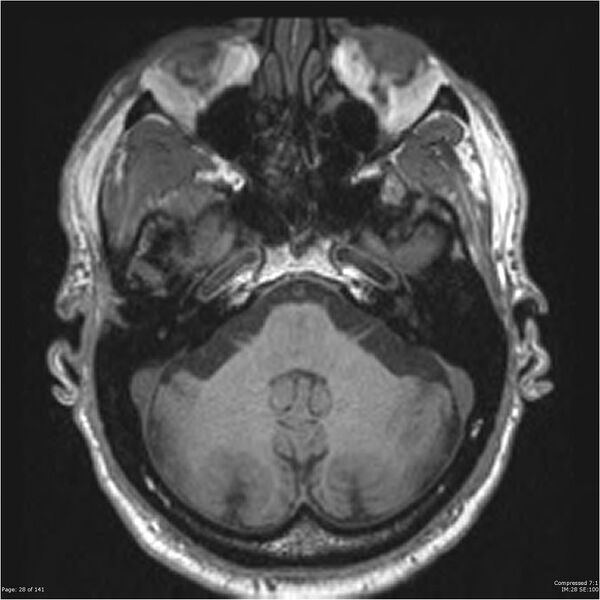 File:Anaplastic meningioma with recurrence (Radiopaedia 34452-35788 Axial T1 26).jpg