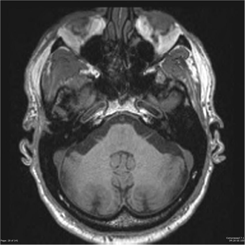 Anaplastic meningioma with recurrence (Radiopaedia 34452-35788 Axial T1 26).jpg