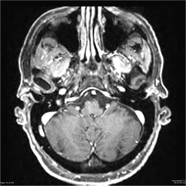File:Anaplastic meningioma with recurrence (Radiopaedia 34452-35788 Axial T1 C+ 25).jpg