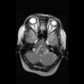 Anaplastic oligodendroglioma NOS (Radiopaedia 10699-11171 Axial T2 16).jpg